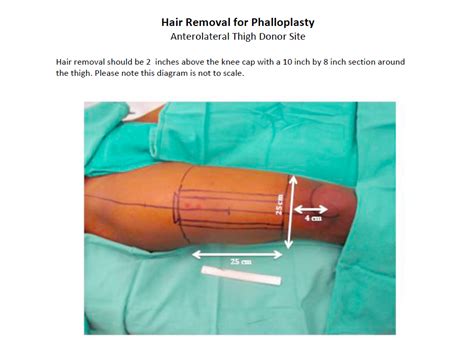 faloplastia|Phalloplasty: Gender Confirmation Surgery